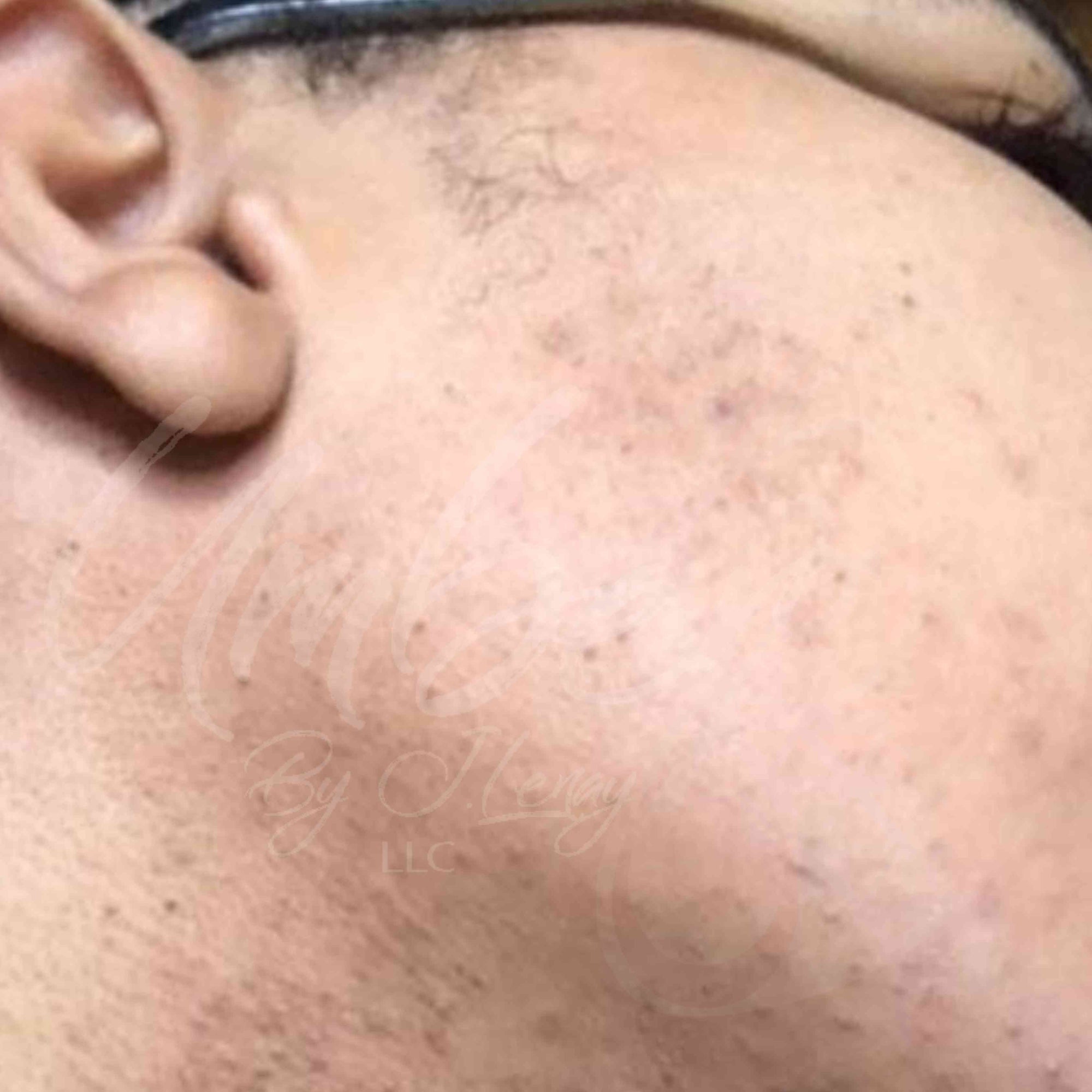 Sideburns and cheeks growth with application of Hair Reducing Fade Oil