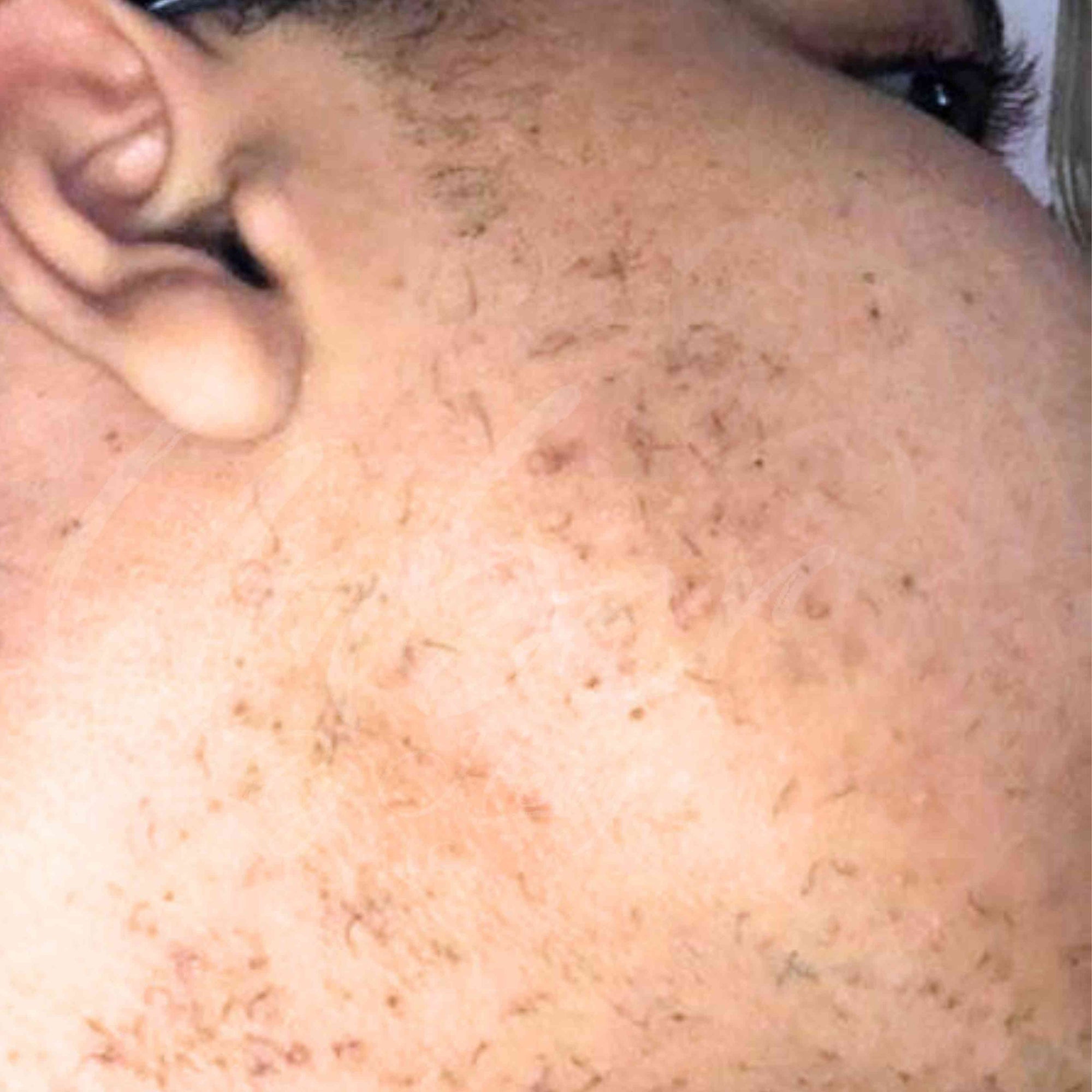 Sideburns and cheeks growth with no application of Hair Reducing Fade Oil