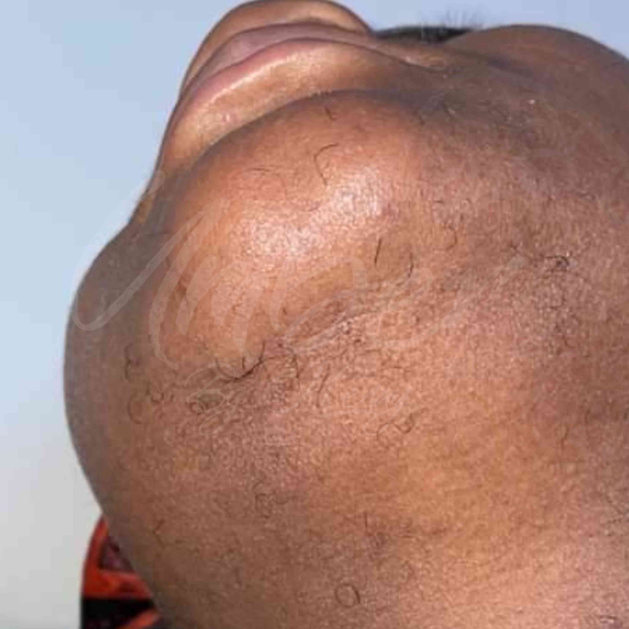 After photo of chin hair growth on customer with Hair Reducing Fade Oil Application