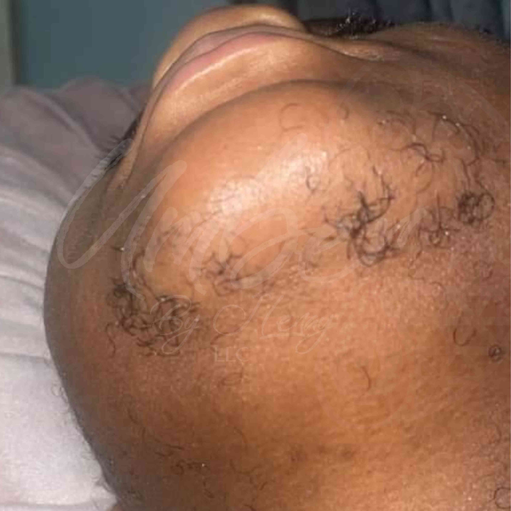 Before photo of chin hair growth on customer with no Hair Reducing Fade Oil Application
