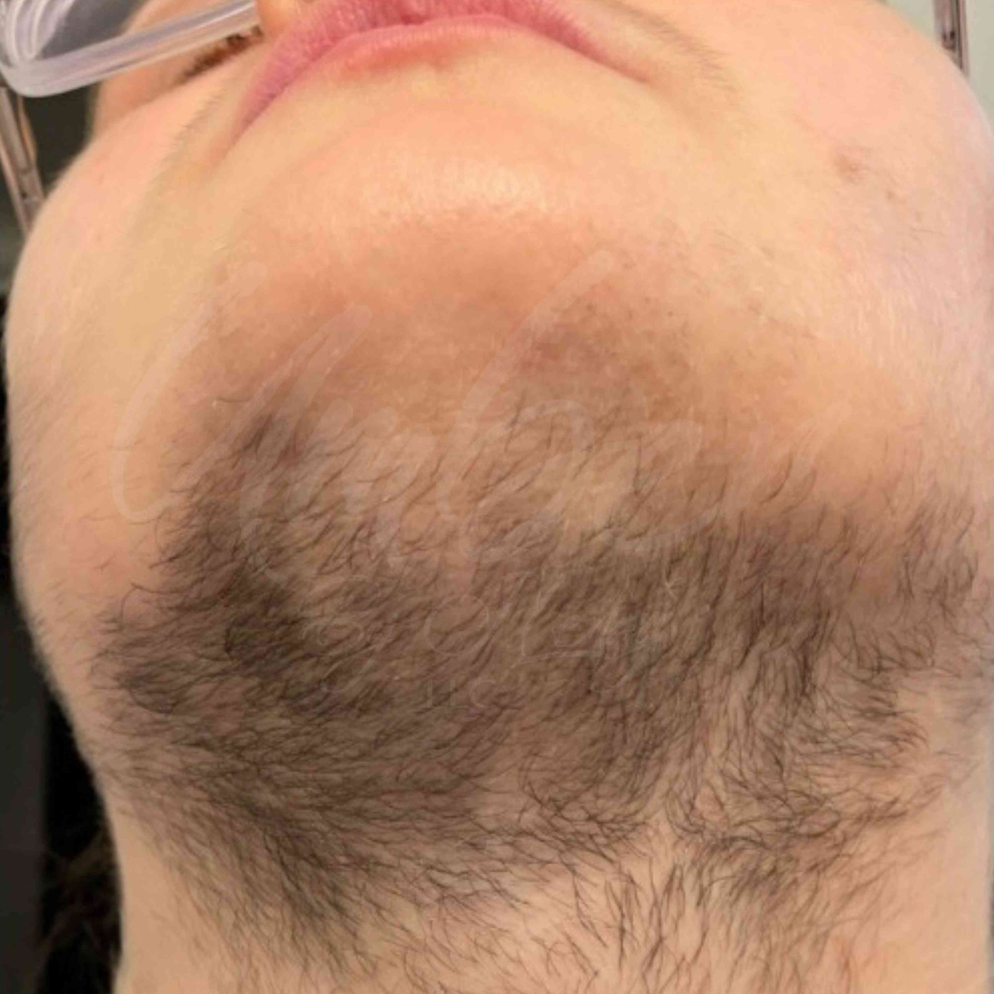 Before photo of neck hair growth on customer with no Hair Reducing Fade Oil Application
