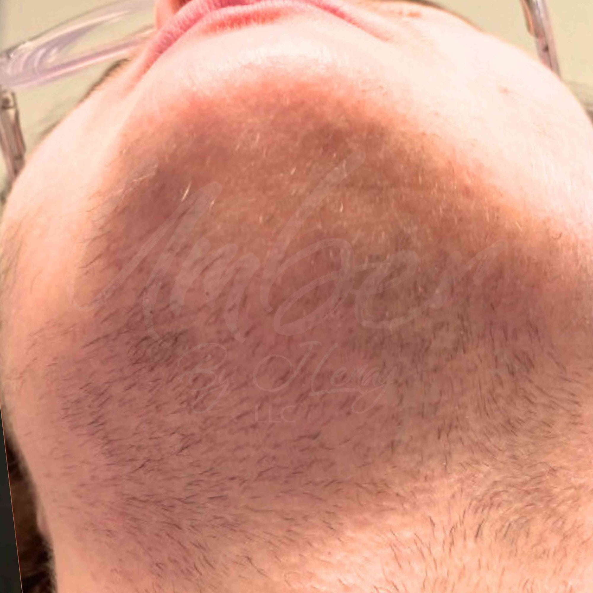 After photo of neck hair growth on customer with Hair Reducing Fade Oil Application