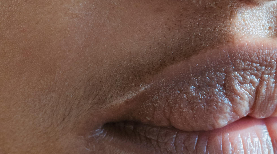 Taming the Fuzz: Practical Tips for Managing PCOS-Related Facial Hair with Hirsutism Oil