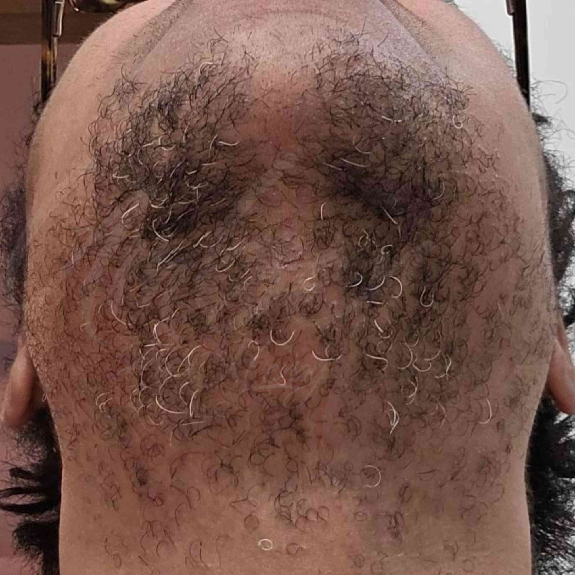 Before photo of neck and chin hair growth on customer with no Hair Reducing Fade Oil Application
