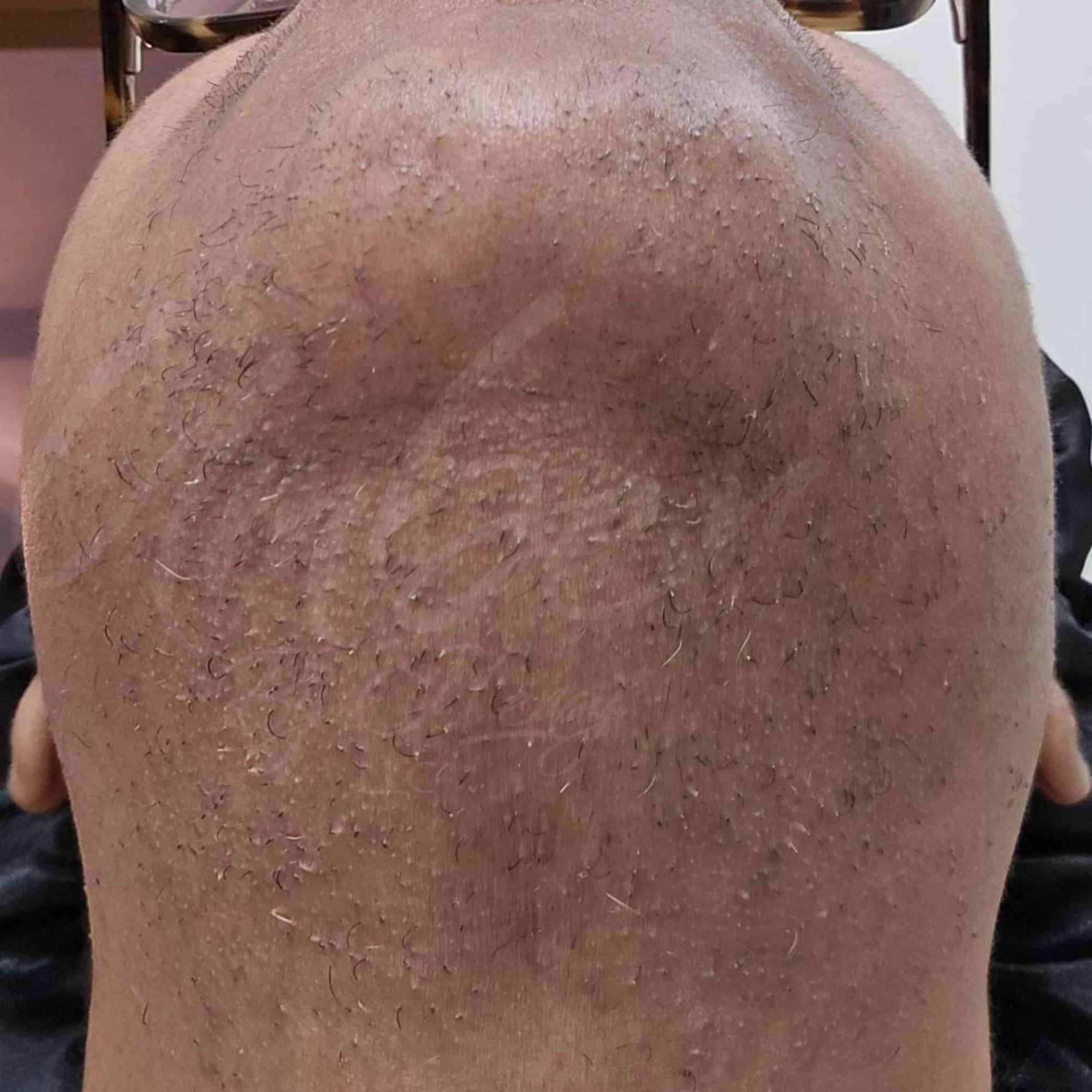 After photo of neck and chin hair growth on customer with Hair Reducing Fade Oil Application