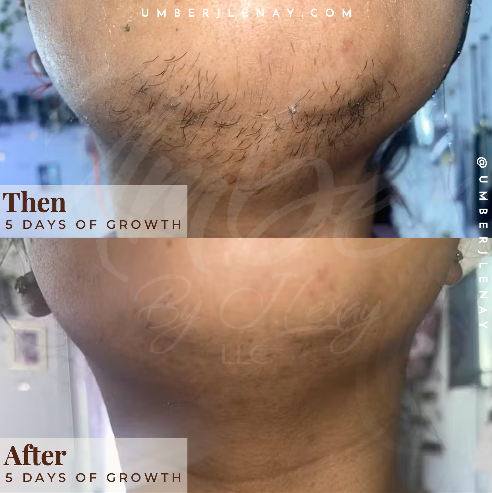 Chin Hair before and after hair reduction oil with 5 days of growth