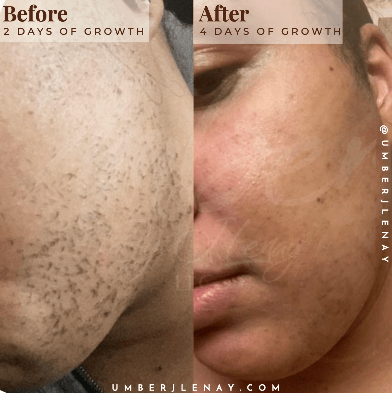 Cheek hair with using hair reducing fade oil comparison between 2 days of growth and 4 days of growth after application