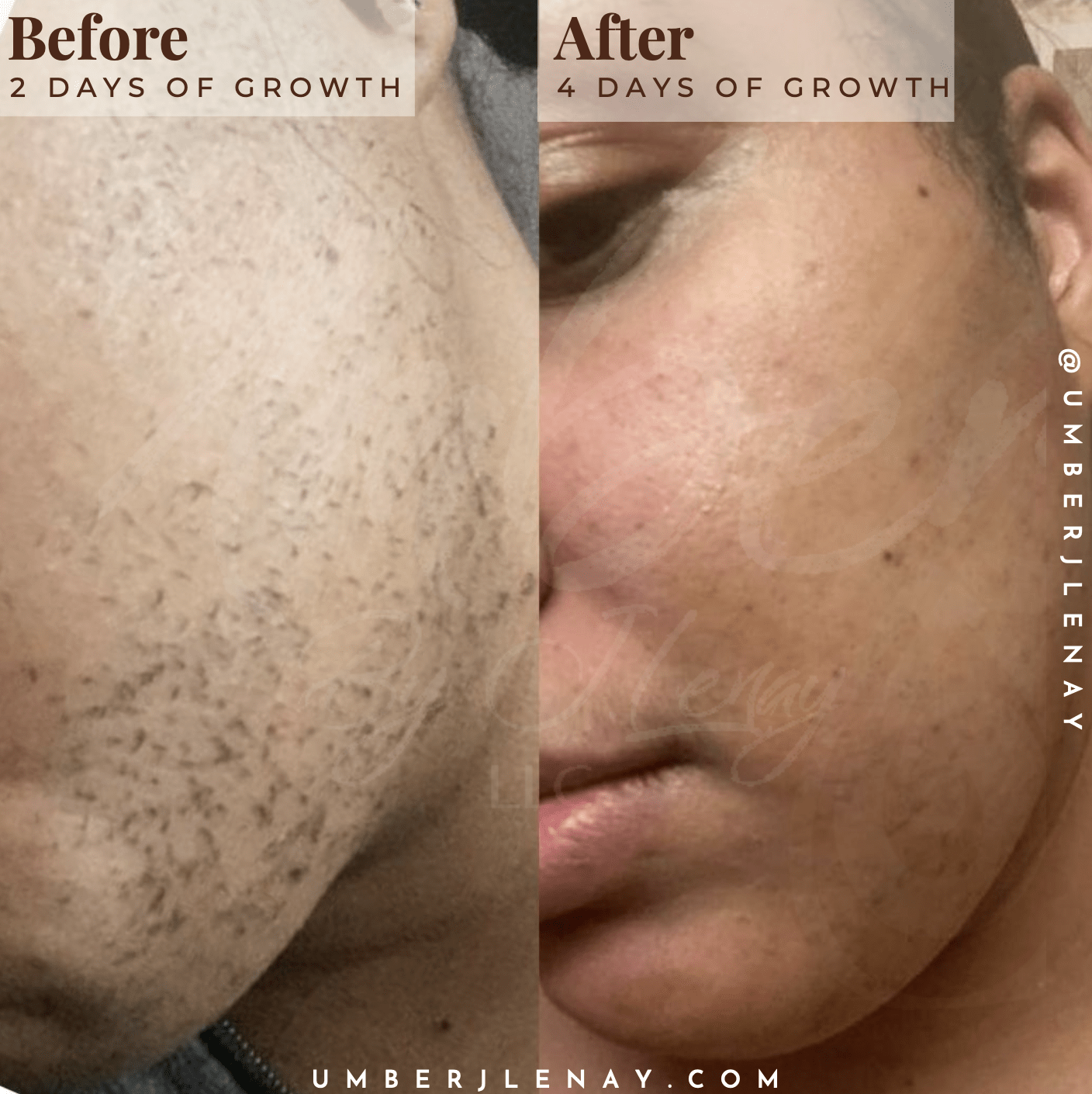 Cheek hair with using hair reducing fade oil comparison between 2 days of growth and 4 days of growth after application
