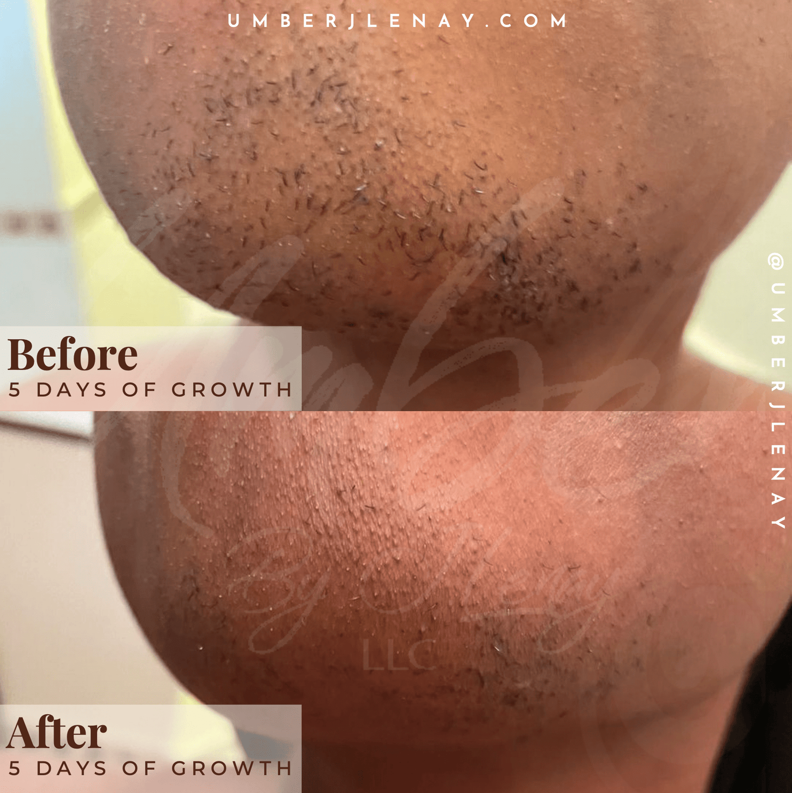 Chin hair before and after using hair reducing fade oil. 5 days of growth