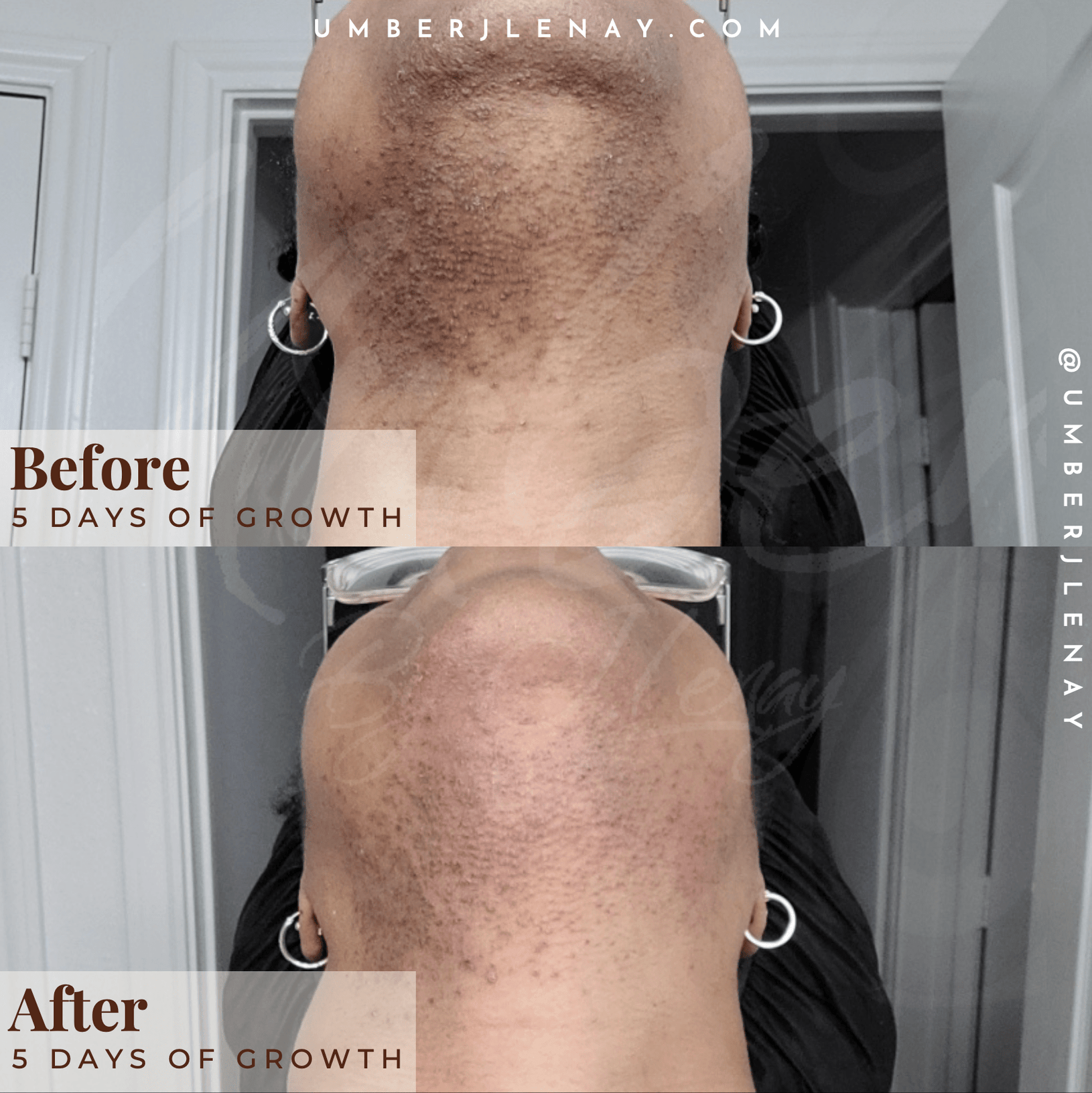 Before and after 5 days of growth using Umber J Lenay products under chin before and after.