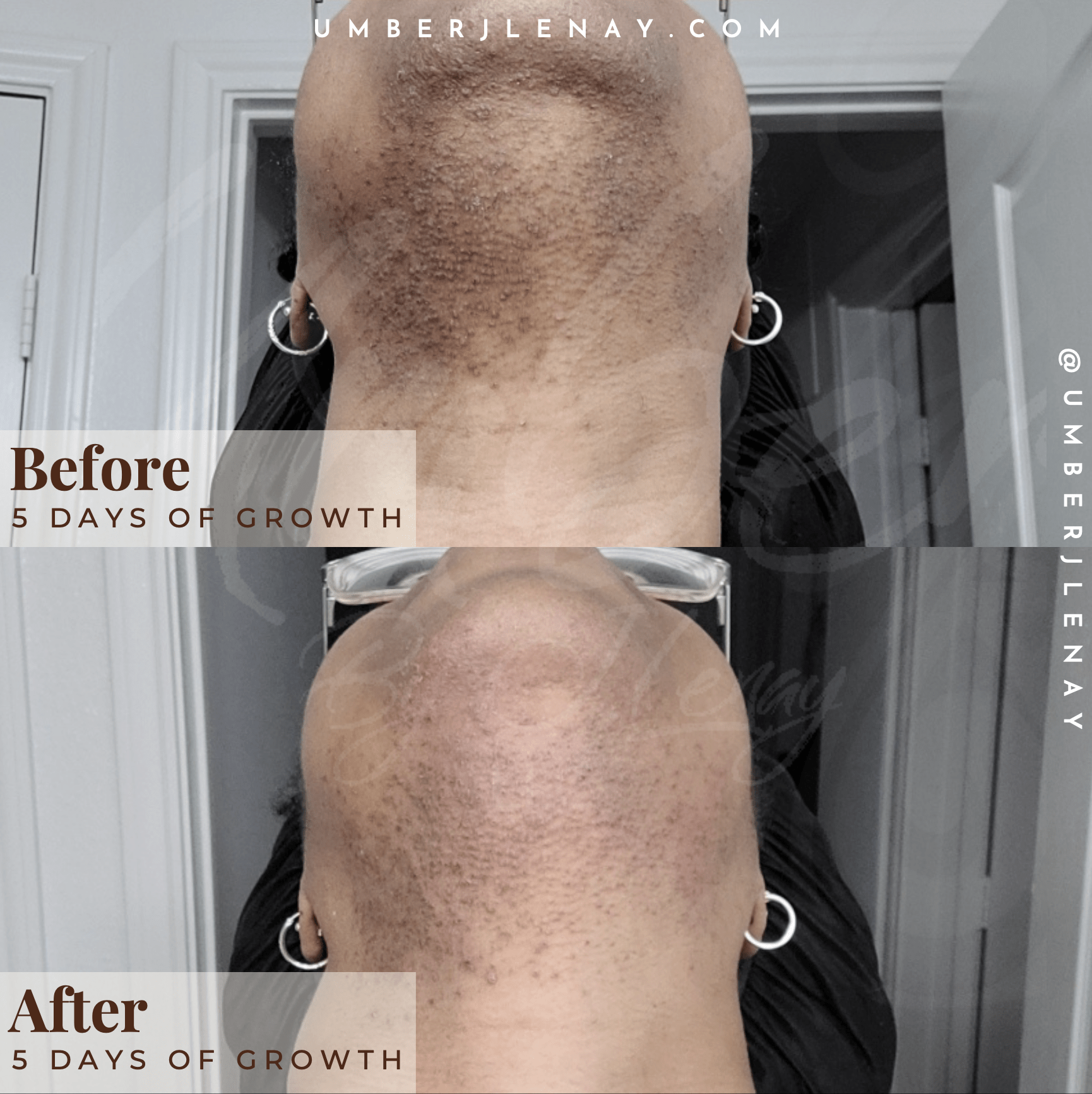 Before and after 5 days of growth using Umber J Lenay products under chin before and after.