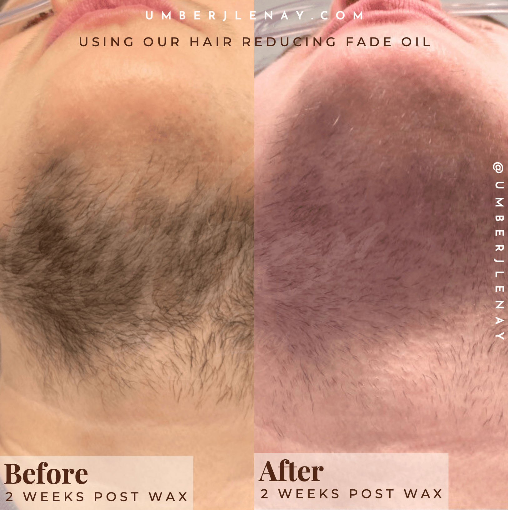 Before and after using Hair Reducing Fade Oil on neck hair. 2 week cycle