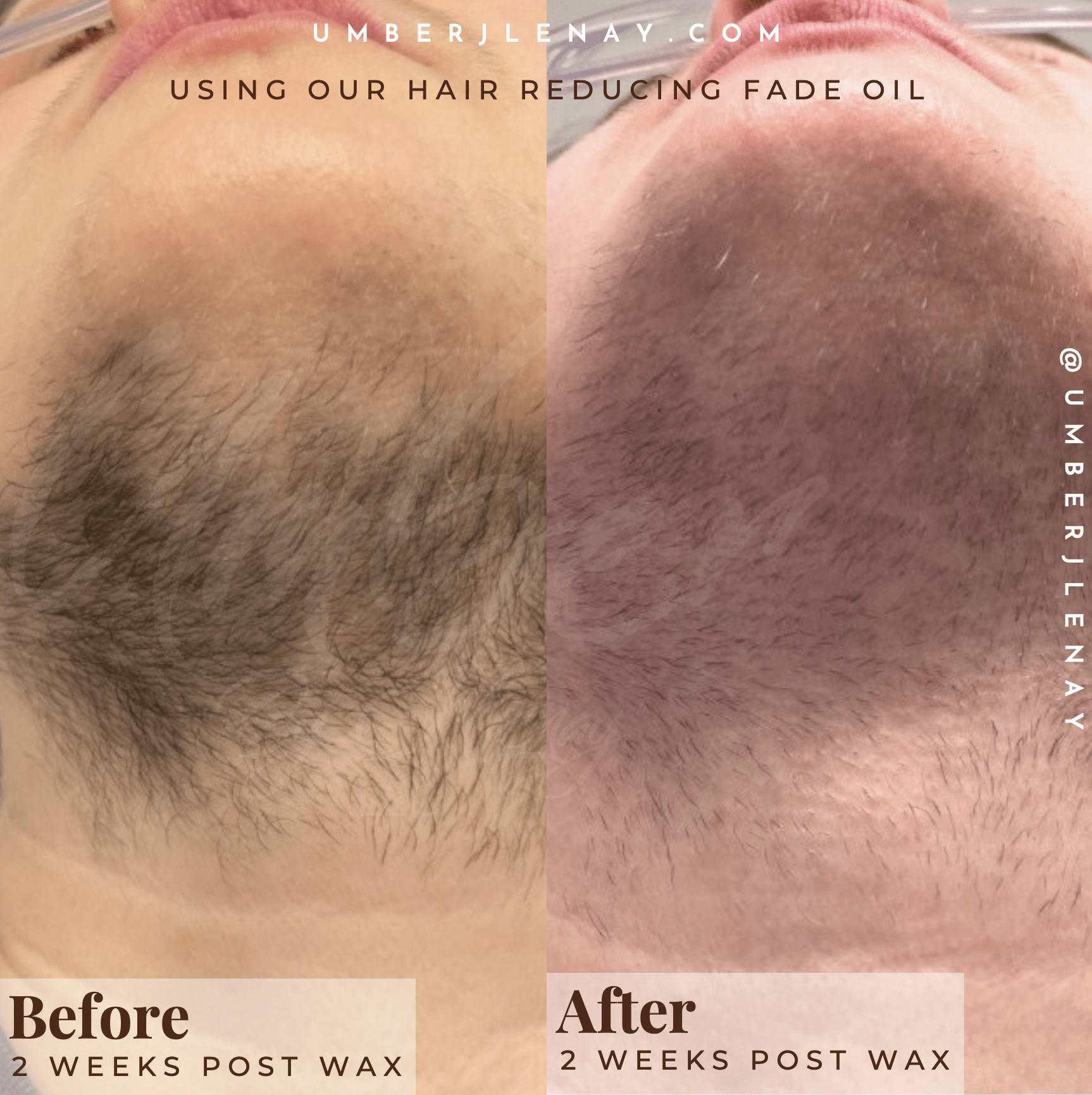 Before and after using Hair Reducing Fade Oil on neck hair. 2 week cycle